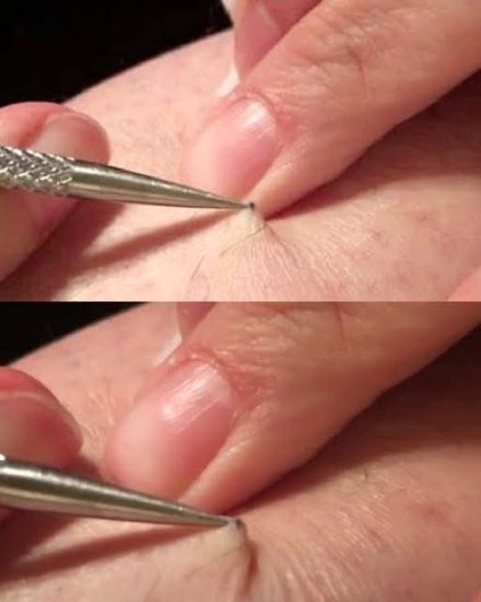 A man discovered a black spot on his leg and began to peel it off. What he removed left millions speechless.
